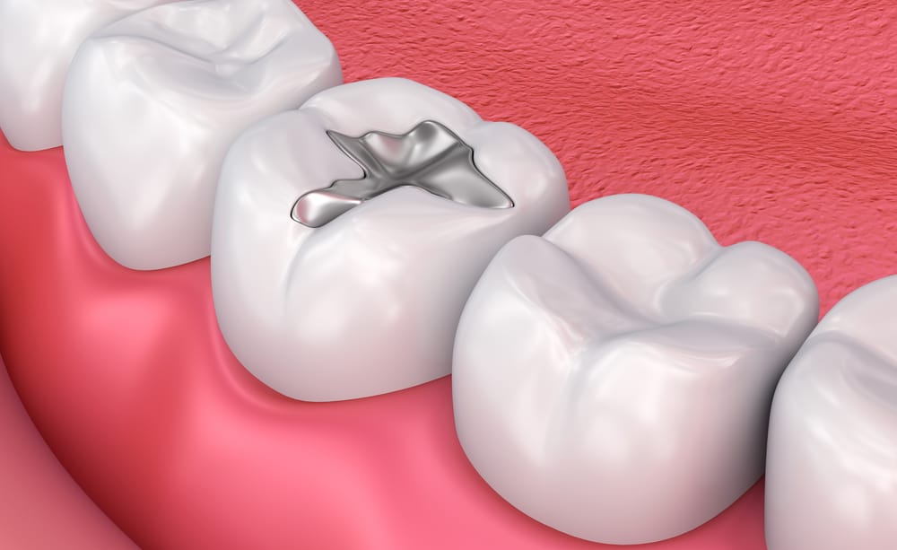 What is Dental Filling Procedure?